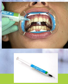 Natural Plus Tooth Whitening at Phuket Dental Clinic,Thailand